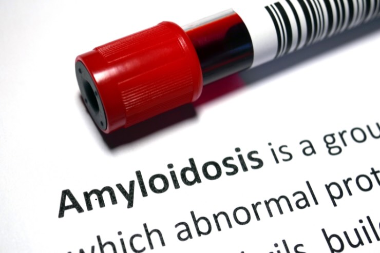 amiloidosi